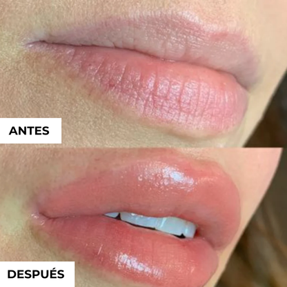 Voluminizador de Labios con Ácido Hialurónico.